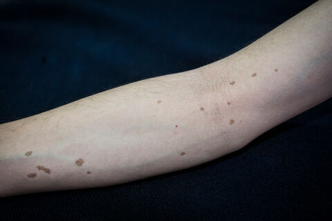  Moles in the form of a constellation on Eduardo's arm. According to his mother the moles appeared after he had been visited by 2 beautiful aliens as a child.